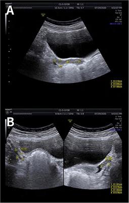 Case Report: Is It Premature Ovarian Insufficiency or Swyer Syndrome After Bone Marrow Transplantation?